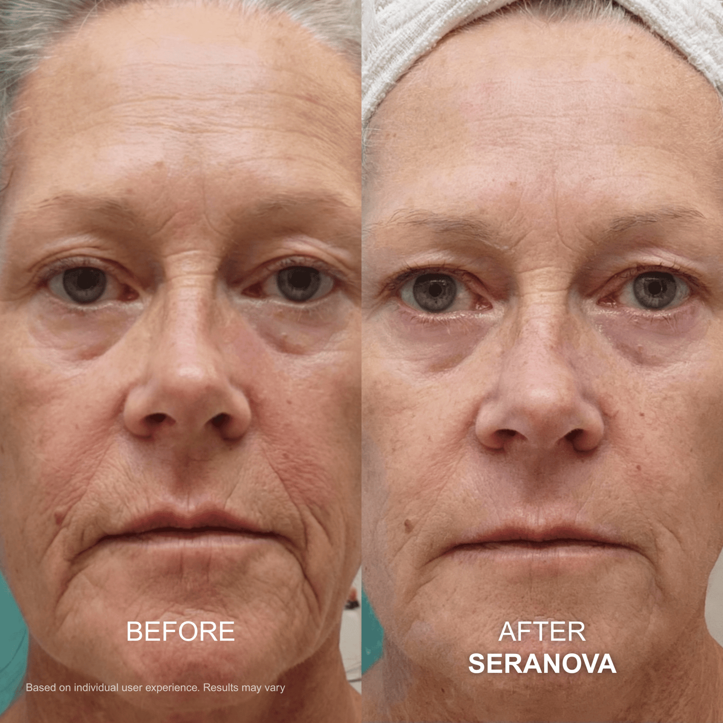 The Micro Infusion System