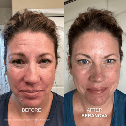 The Micro Infusion System